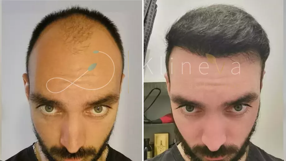 Avant et après une greffe de cheveux FUE Saphir : 3 752 greffons, résultat à 9 mois
