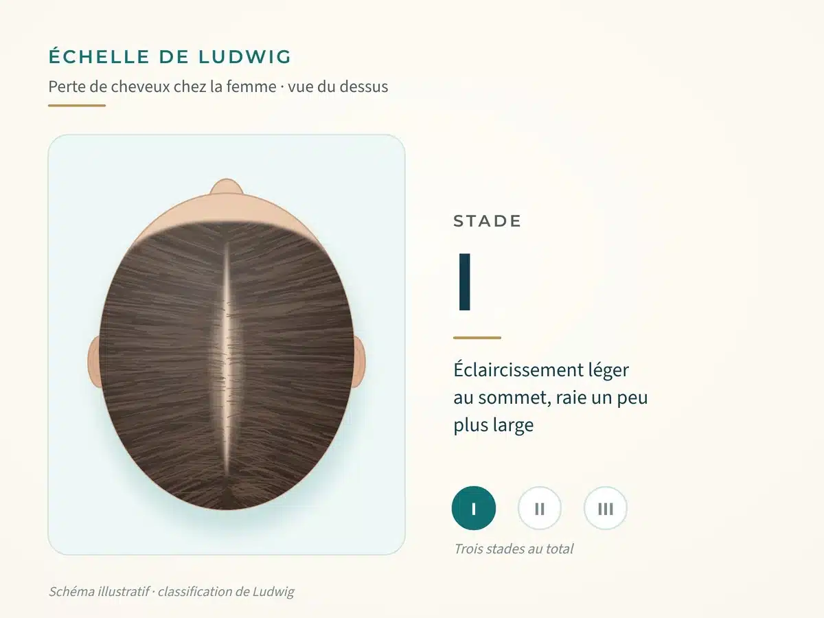 Schéma de l'échelle de Ludwig, stade I : léger éclaircissement au sommet, raie un peu plus large