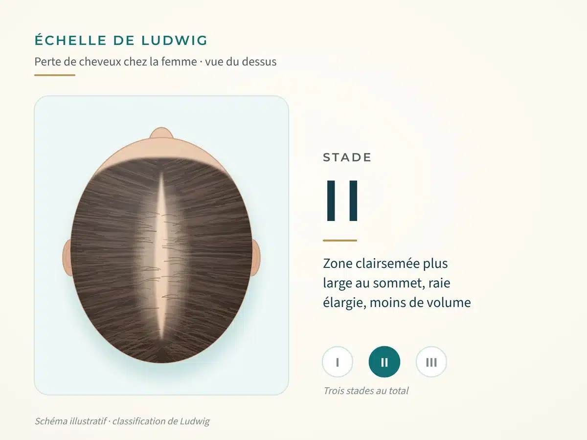 Schéma de l'échelle de Ludwig, stade II : zone clairsemée plus large au sommet, raie élargie