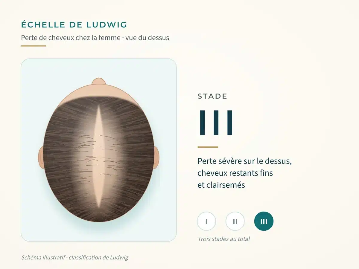 Schéma de l'échelle de Ludwig, stade III : perte sévère sur le dessus, cheveux restants fins et clairsemés