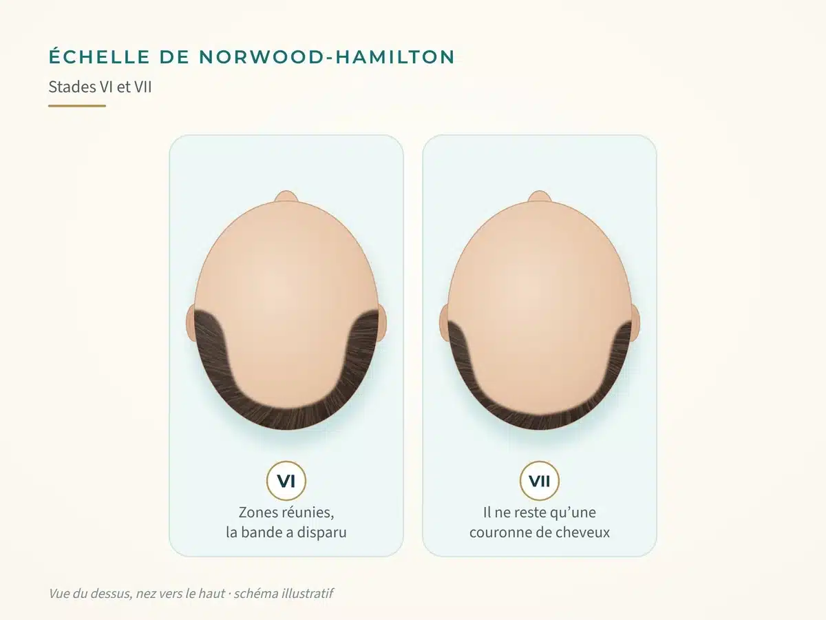 Schéma de l'échelle de Norwood-Hamilton : stades VI et VII, têtes vues du dessus