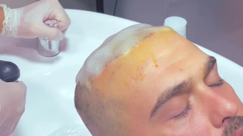 Premier lavage après la greffe de cheveux, réalisé à la clinique sur un patient installé au bac